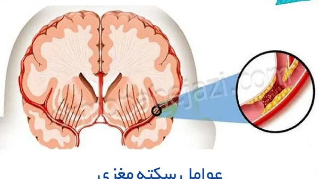 علل سکته مغزی با بهترین متخصص مغز و اعصاب ایران