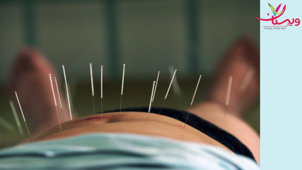 فرایند کاشت نخ با طب سوزنی