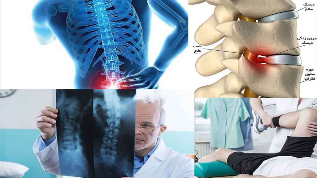 کمر درد جابجایی مهره های کمر