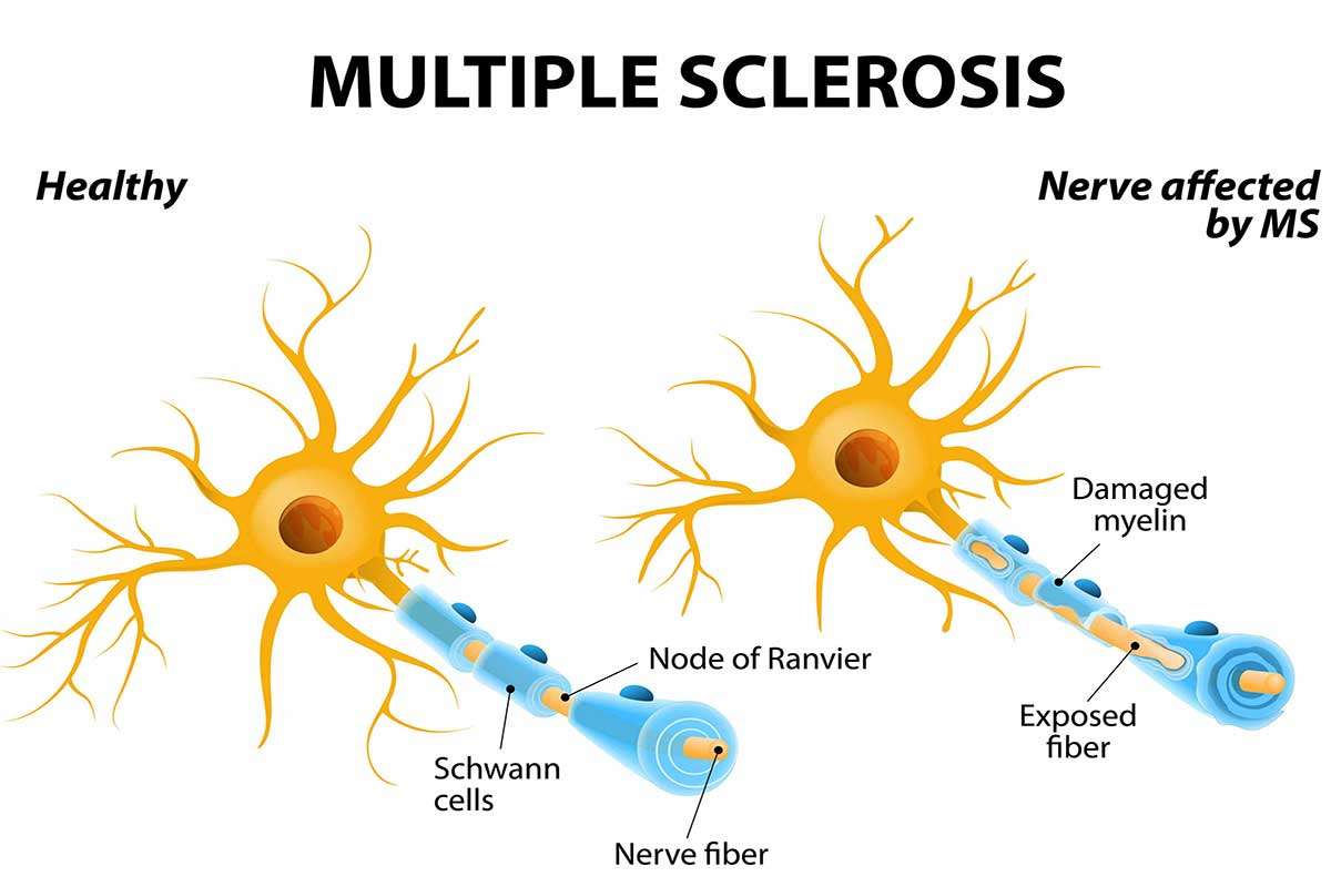 درمان MS ام اس چیست
