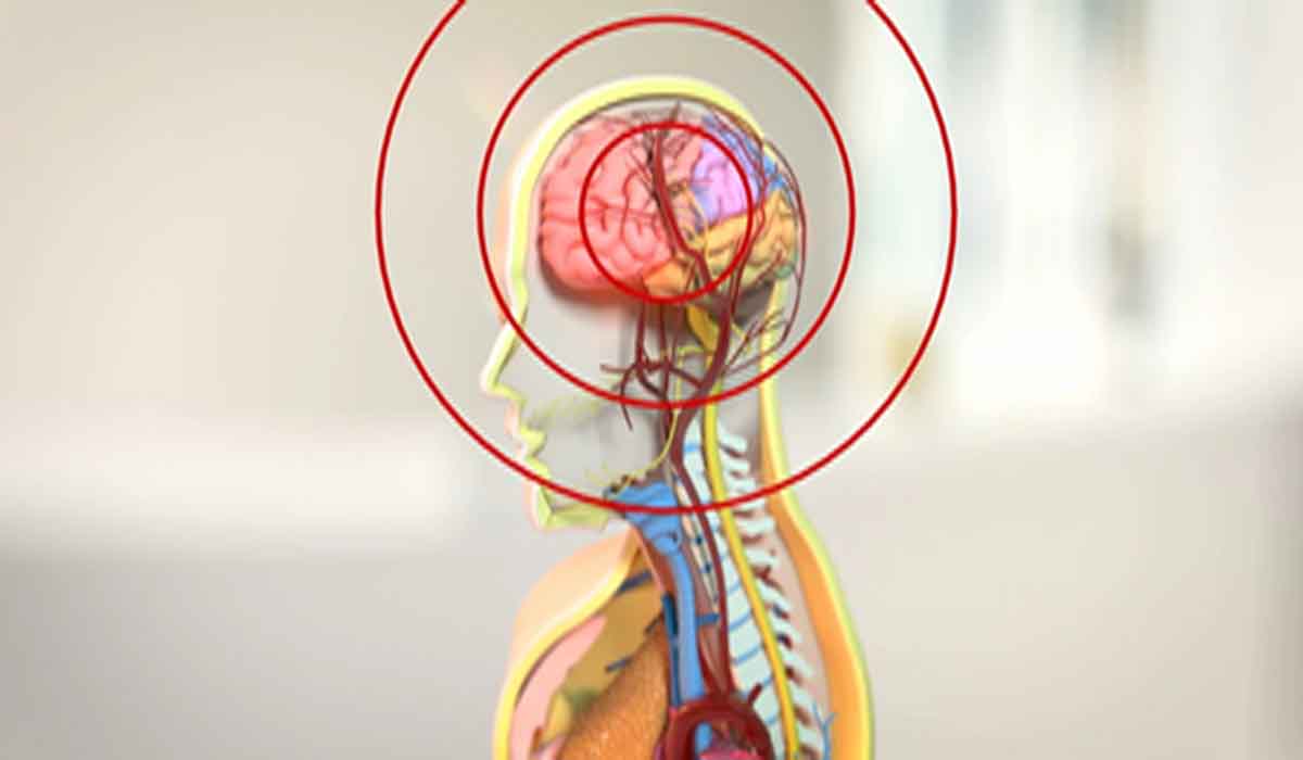 میگرن و مناطق درگیر