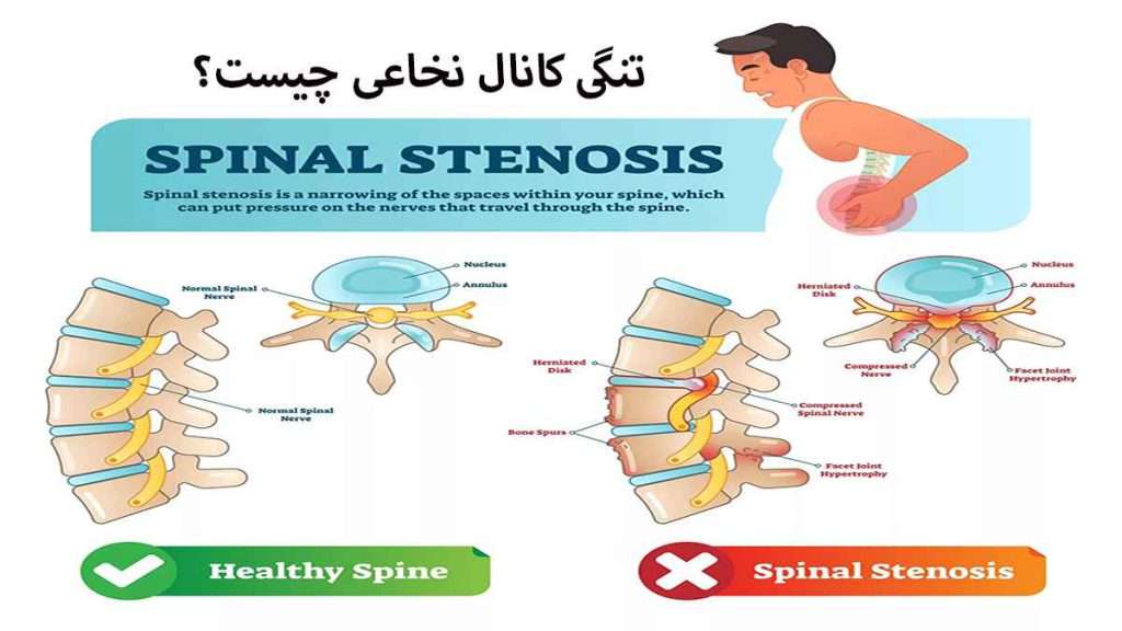 متخصص تنگی کانال نخاعی