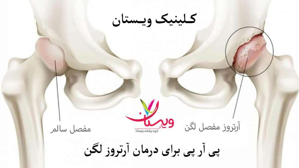 آرتروز مفصل لگن و مقایسه آن با لگن سالم
