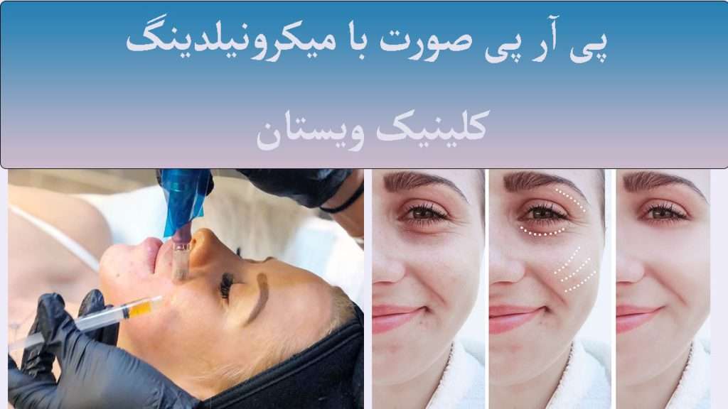 جوانسازی پوست با پی آر پی و میکرونیلدینگ جوانسازی پوست و تزریق پی آر پی به صورت توسط پزشک