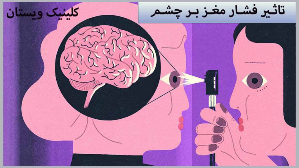 تاثیر فشار مغز بر چشم از نظر پزشکان متخصص