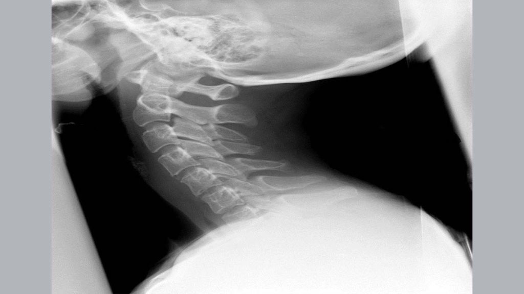 تشخیص آرتروز گردن با اشعه ایکس