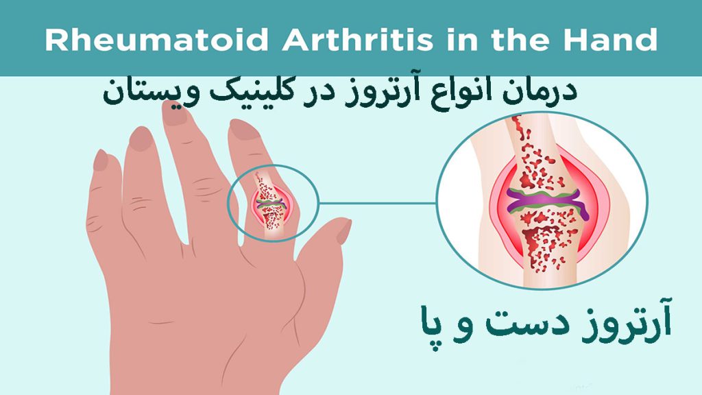 دست یک شخص که به آرتروز مبتلا شده است
