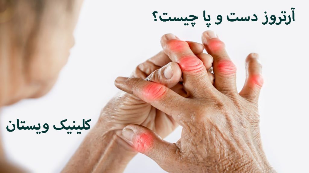 یک خانم که دچار آرتروز انگشت دست است-یک نوشته با عنوان آرترروز دست و پا چیست؟