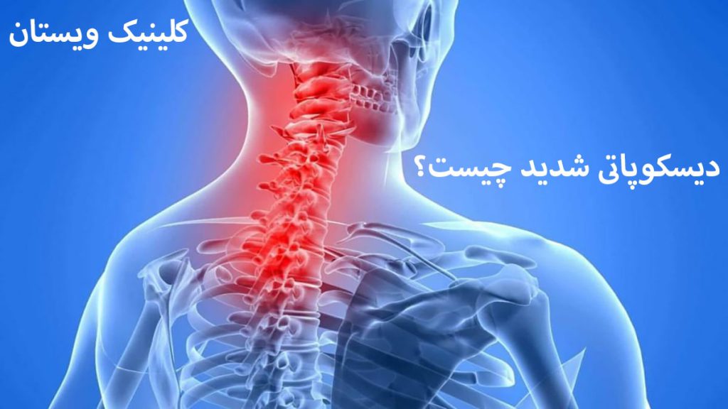 دیسکوپاتی شدید درد شدید در ناحیه گردن