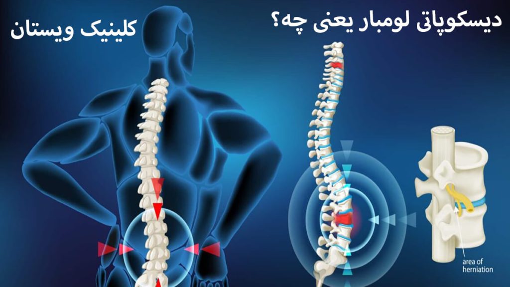 دیسکوپاتی لومبار ستون فقرات و درد در ناحیه کمر و گردن