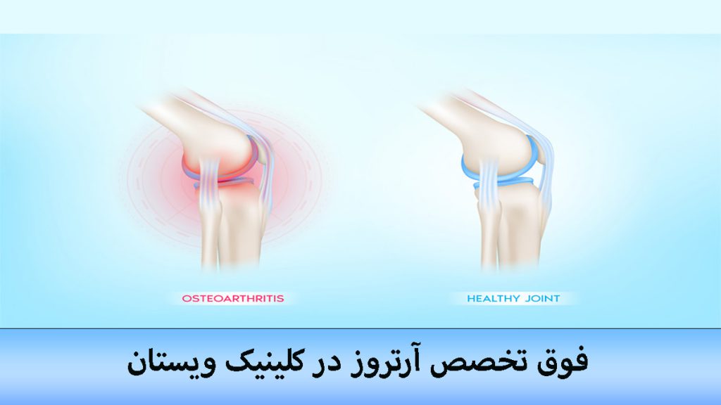یک استخوان زانو سالم و یک استخوان زانوی دچار آرتروز