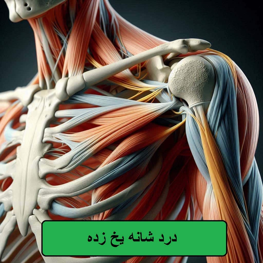 علت وعلائم شانه یخ زده درد شانه یخ زده * علل ،علائم و راهکارهای موثر برای درمان