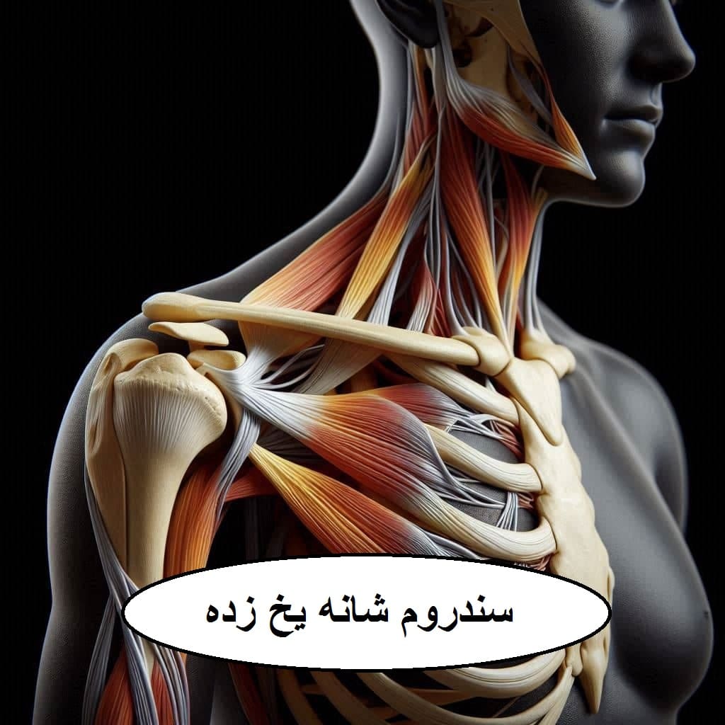 سندروم شانه یخ زده و درمان آن شانه فردی که دچار درد شده است