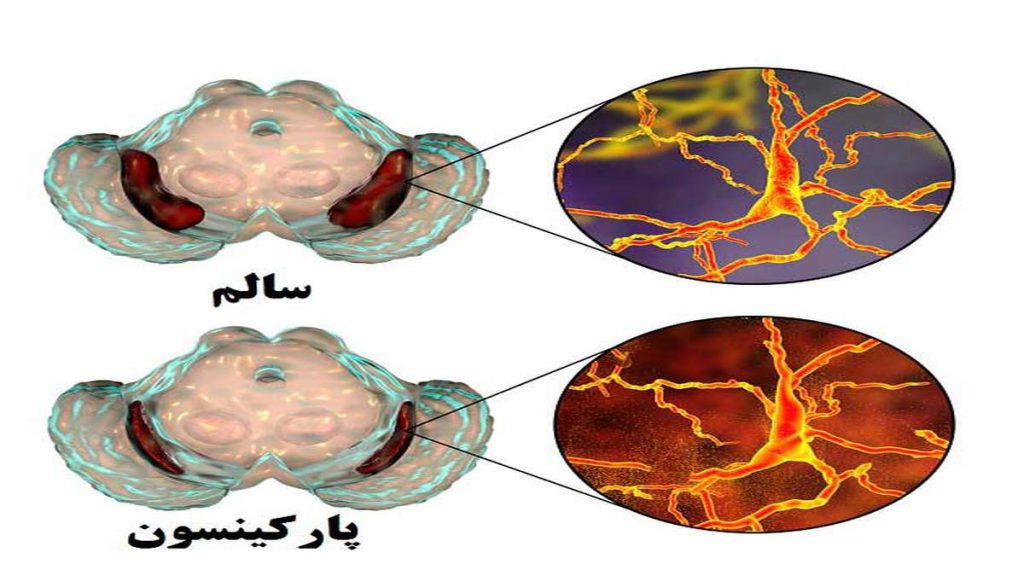 بیماری پارکینسون 