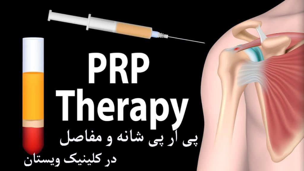 پی آر پی شانه پی آر پی شانه-یک سرنگ در حال تزریق به شانه و ظرف پی آر پی