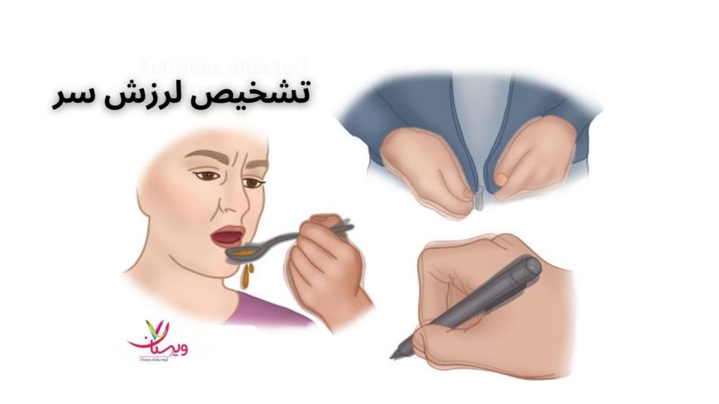 برای تشخیص لرزش سر چه آزمایشی بدهیم