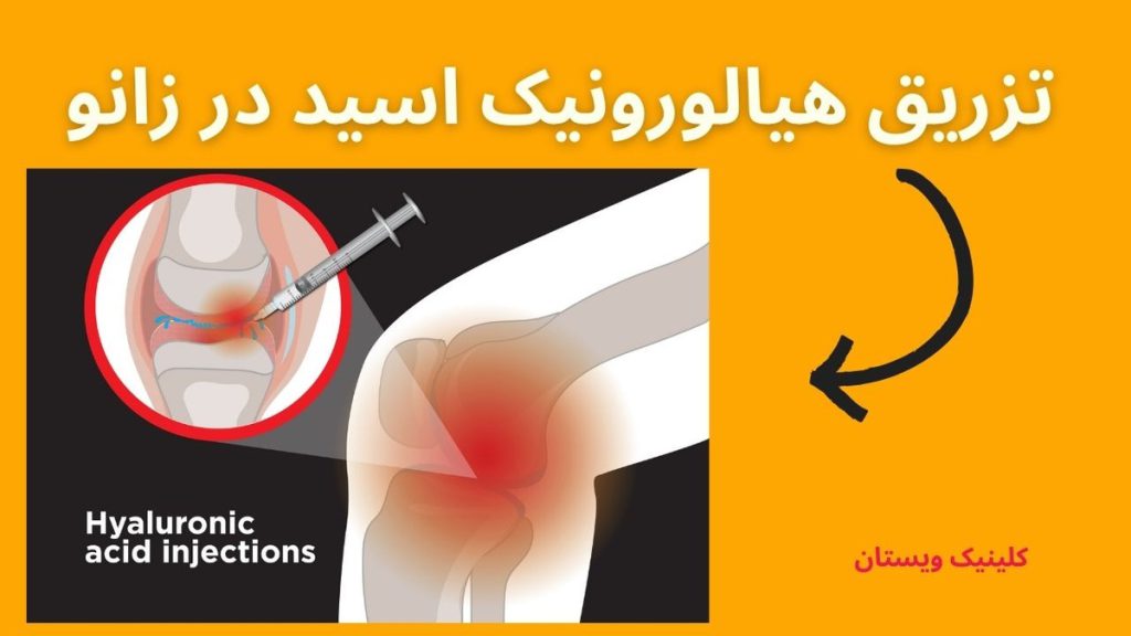 تزریق هیالورونیک اسید در زانو