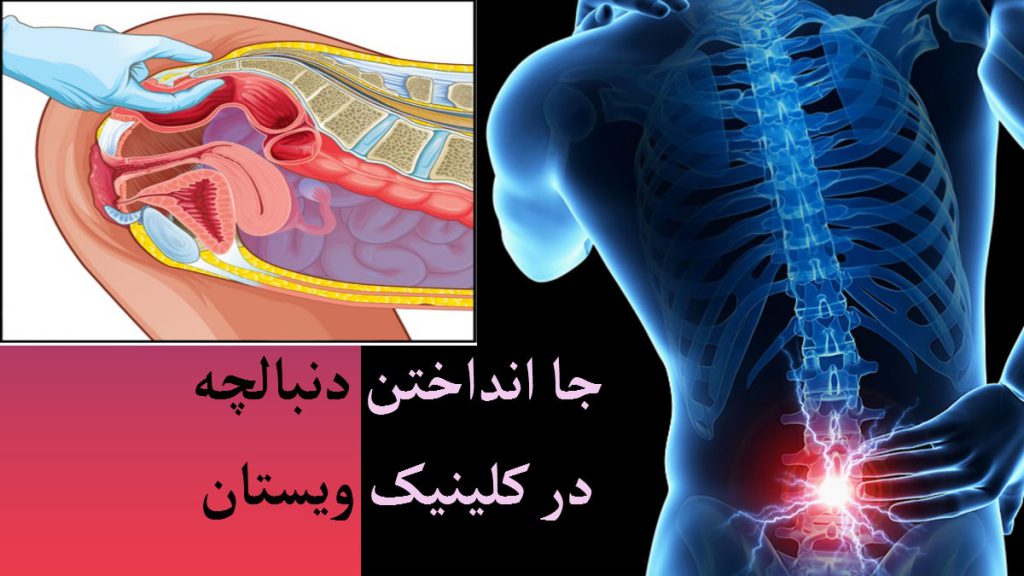 دو تصویر از استخوان دنبالچه -در رفتگی دنبالچه و جا انداختن آن
