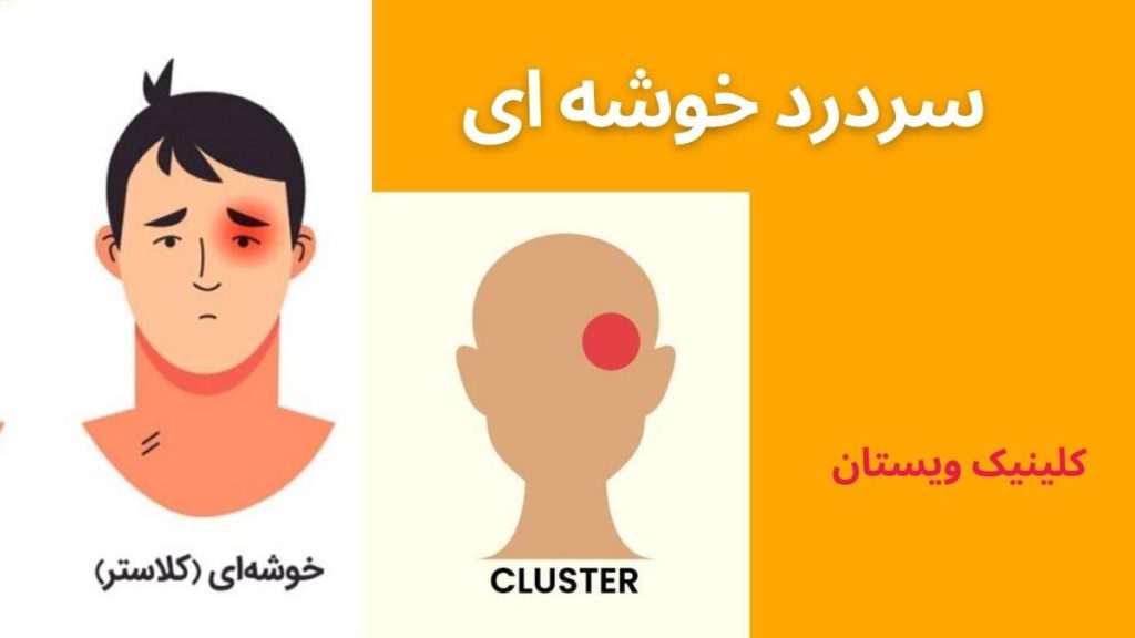 درد شدید و سوزاننده در اطراف یک چشم و ناحیه گیجگاهی