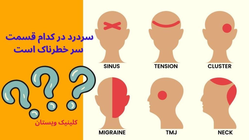 سردرد در تمام ناحیه سر