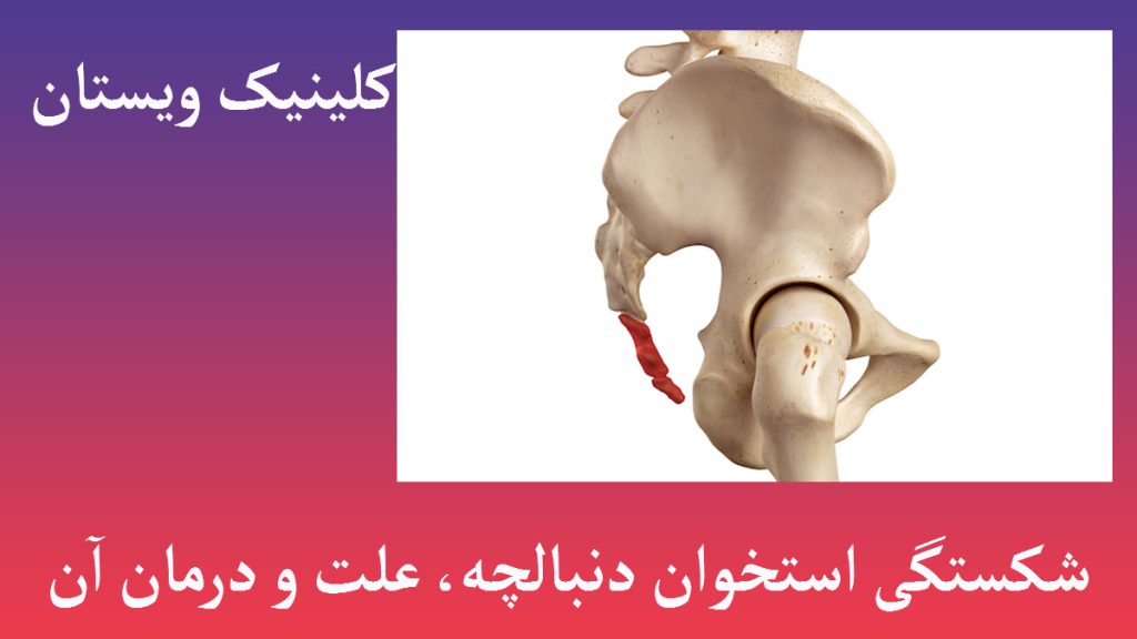یک استخوان لگن و دنبالچه که دچار مشکل شده است