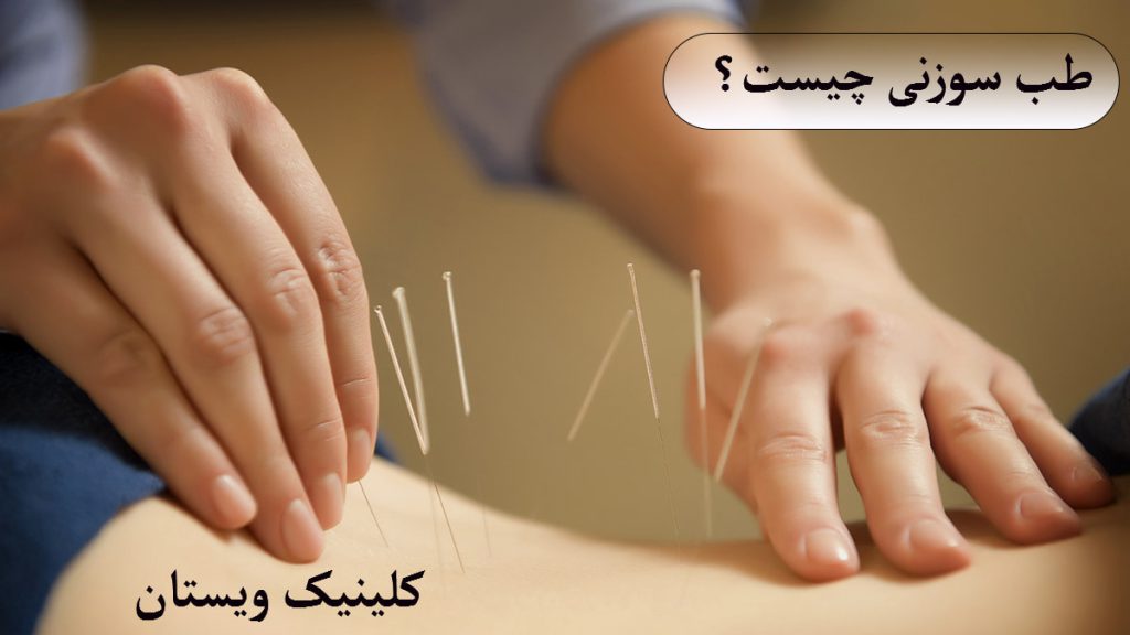 یک پزشک در حال انجام طب سوزنی کمر