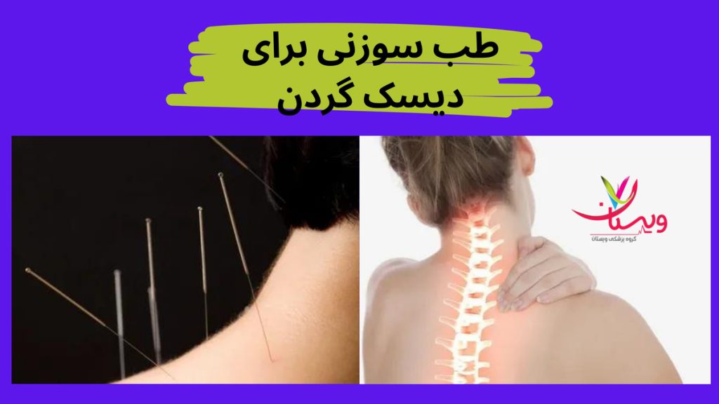 کاهش التهاب در ناحیه گردن طب سوزنی برای دیسک گردن