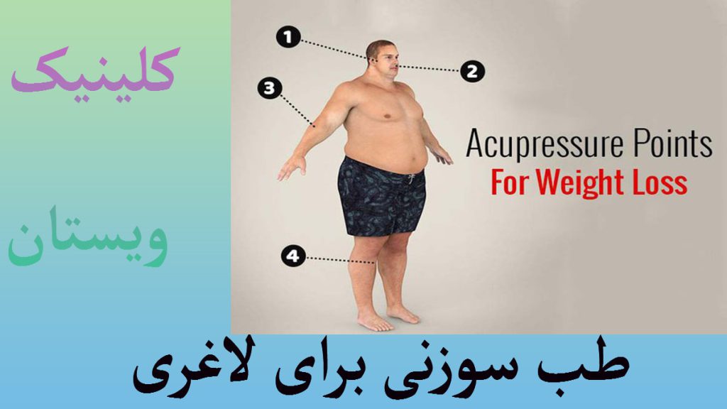 یک شخص که دارای اضافه وزن است و نقاطی از بدن او برای لاغری با طب سوزنی علامت گذاری شده اند