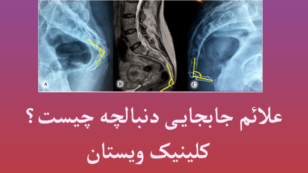 سه گرافی از مشکلات دنبالچه در یک قاب