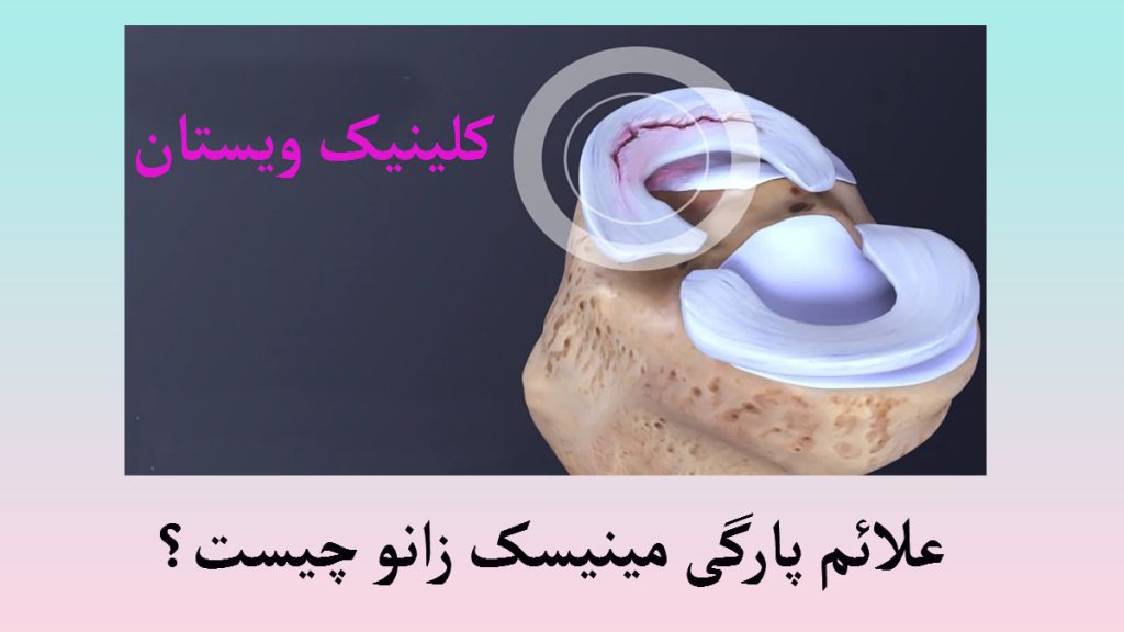یک مینیسک زانو که دچار پارگی شده است