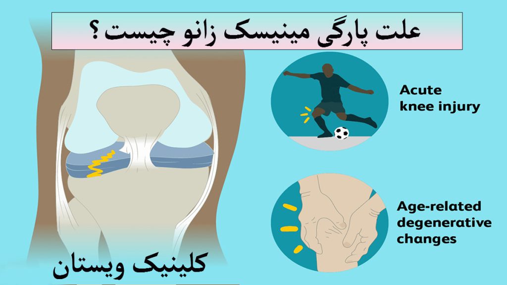چند تصویر از علت پارگی مینسیک زانو