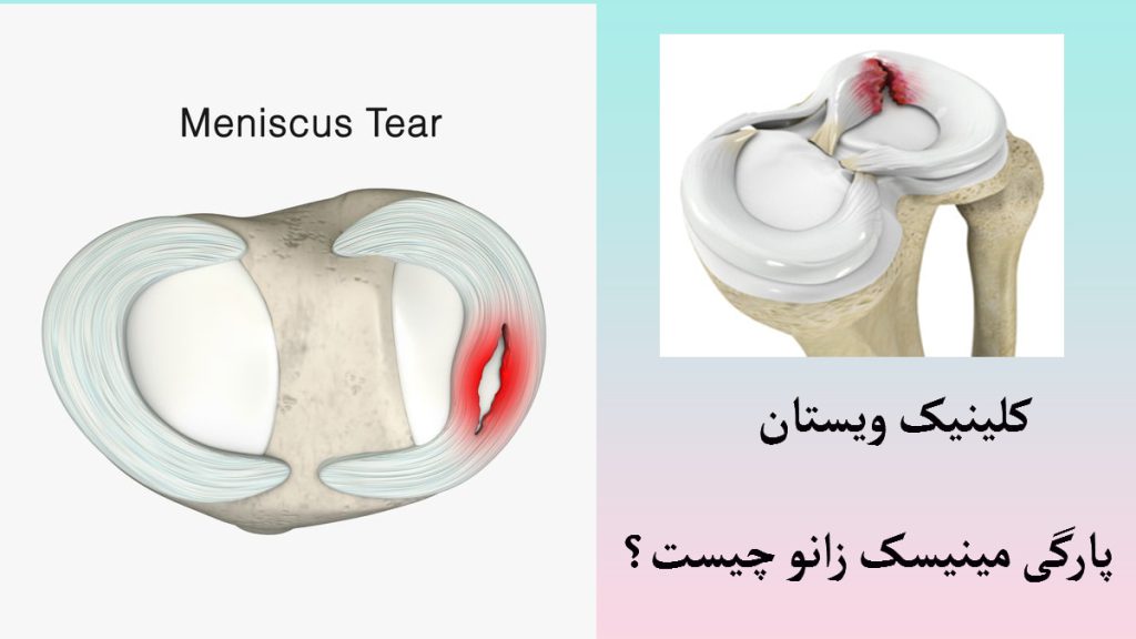 دو تصویر در کنار هم که پارگی مینیسک زانو را نشان می دهند
