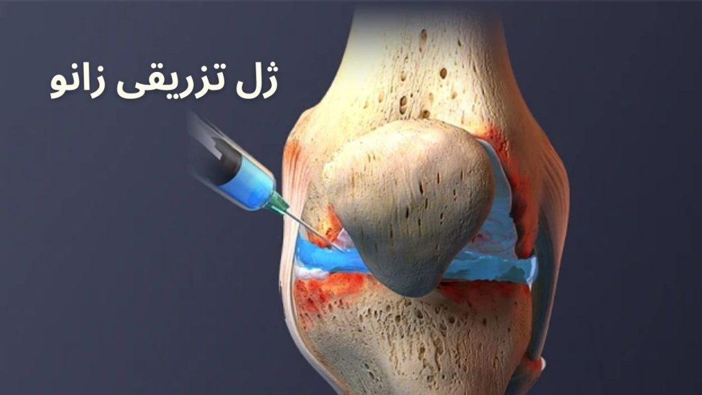 ژل تزریقی زانو