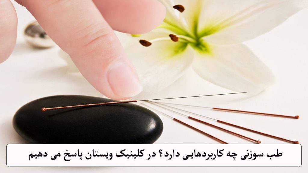 چند سوزن برای طب سوزنی 