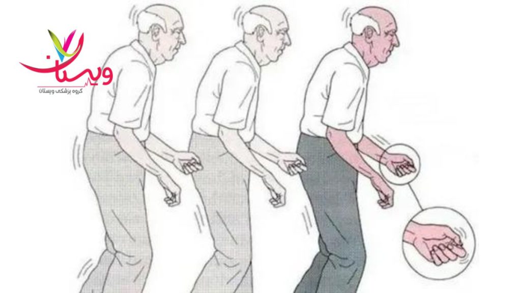 پارکینسون ایدیوپاتیک انواع بیماری پارکینسون