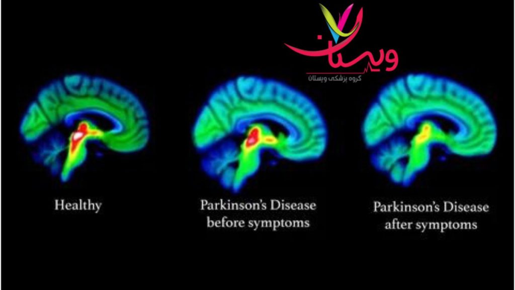 پزشک برجسته پارکینسون بهترین دکتر برای تشخیص علائم اولیه پارکینسون در تهران