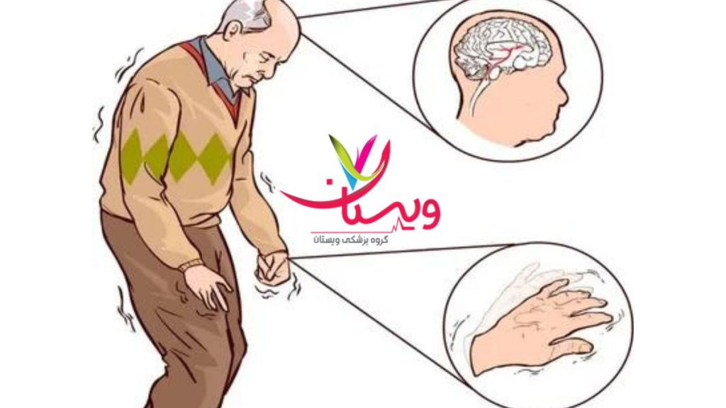 بیماران پارکینسون بهترین ویتامین برای بیماری پارکینسون چیست