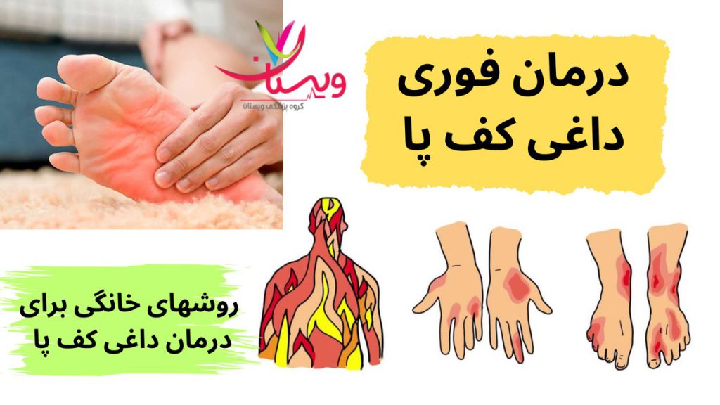 درمان فوری داغی کف دست و پا