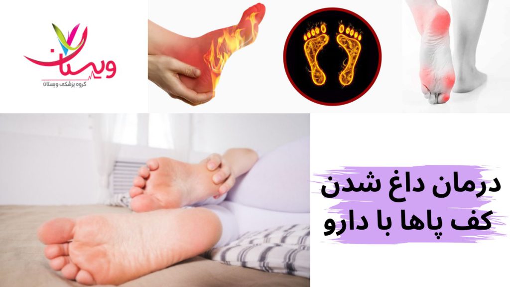 درمان داغ شدن کف پاها با دارو