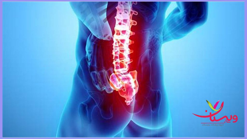 درد دنبالچه و سیاتیک-علت درد دنبالچه هنگام نشستن چیست؟