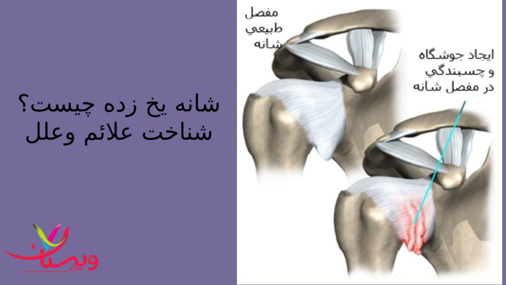 مراحل شانه منجمد یا کپسولیت چسبنده تفاوت مفصل شانه سالم ومفصل یخ زه