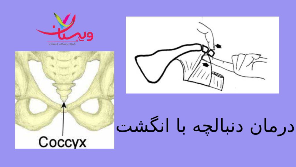 روش غیر جراحی درمان با انگشت یکی از راه های درمان درد دنبالچه درمان با انگشت است