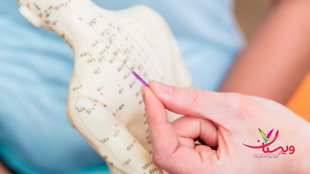 پزشکی که با سوزن طب سوزنی برای درمان بیماری که دچار شانه یخ زده شده است اقدام به درمان می کند