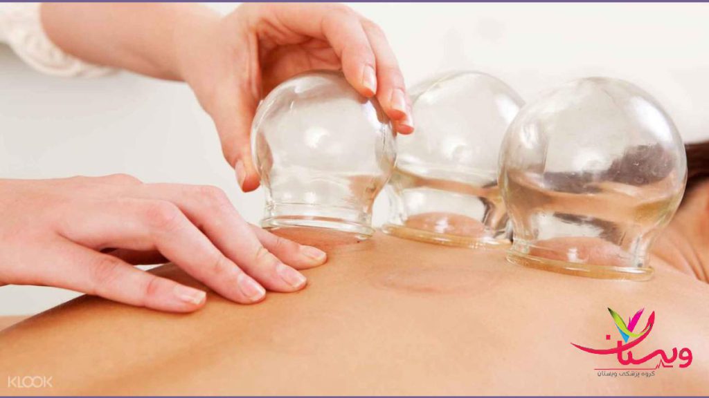 بادکش یک روش درمانی سنتی است استفاده از لیوان های بادکش درمانی روی بدن بیمار
