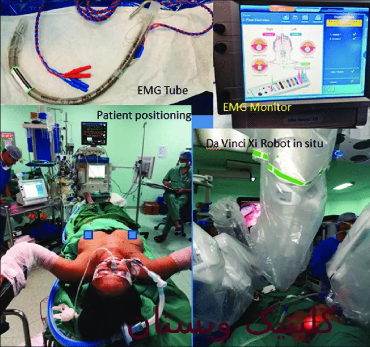 آسیب به اعصاب میتواند موجب ضعف یا فلج عضلات شود. عصاب و عضلات از طریق سیناپسها صورت میگیرد.