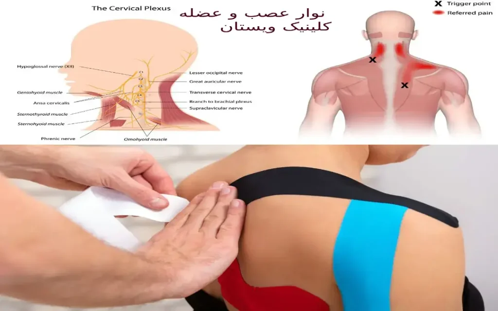 نوار عصب یک روش پزشکی است که برای ارزیابی عملکرد سیستم عصبی استفاده میشود. اعصاب با انتقال سیگنالهای حسی، بدن را از محیط اطراف آگاه میکنند.