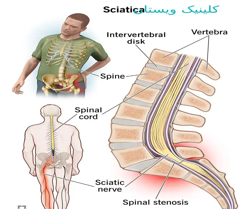 سیاتیک و بهترین آمپول برای درد سیاتیک