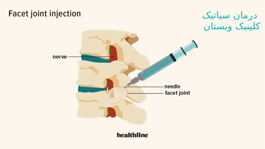 سیاتیک و بهترین آمپول برای درد سیاتیک