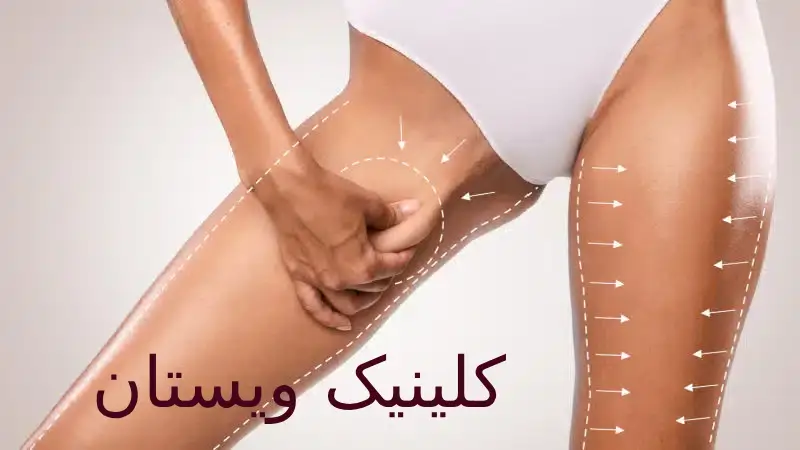 نخ لاغری با تحریک متابولیسم، فرآیند چربیسوزی را تسریع میکند. نخ لاغری به عنوان یک راهکار موثر برای کاهش وزن در بسیاری از افراد بهکار میرود.