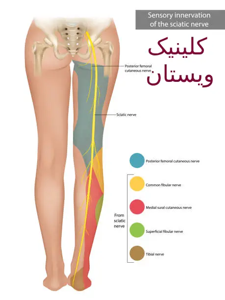 تزریق PRP درمان سیاتیک